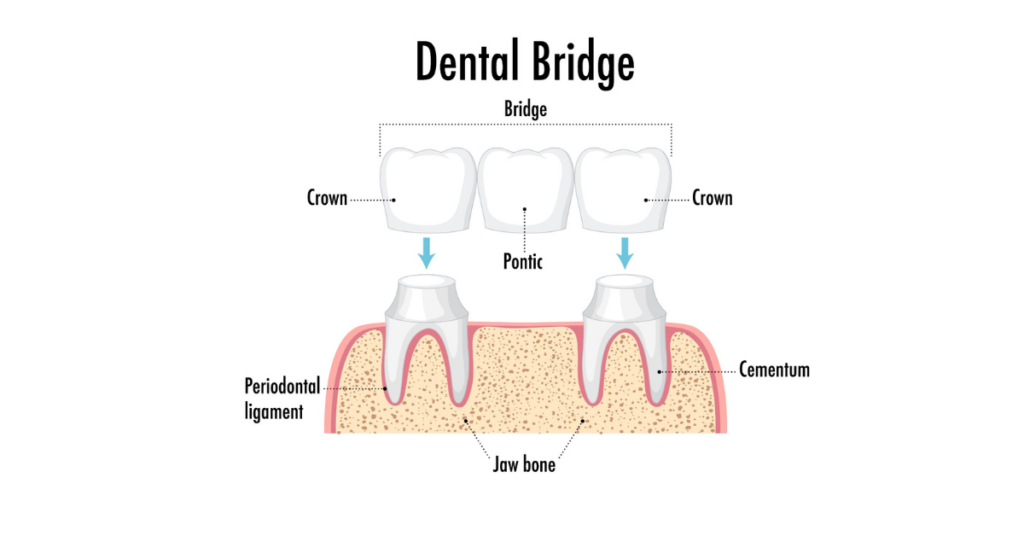 dental bridge in Indore