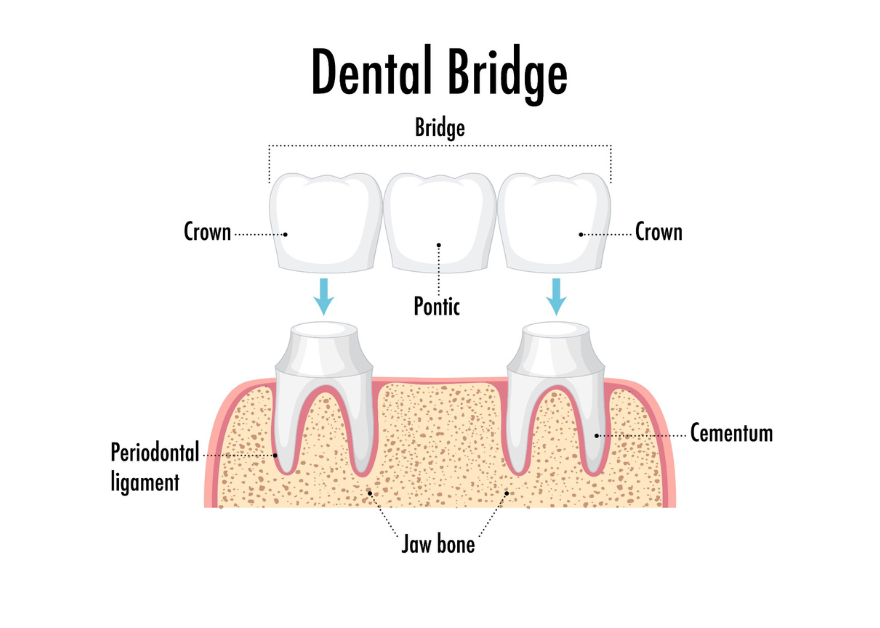 dental bridge in Indore