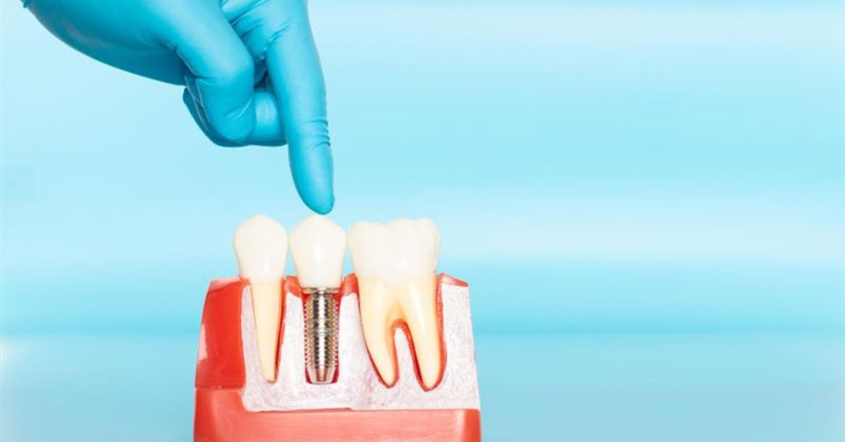 root canal in indore
